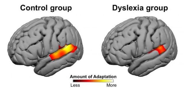 Risultato immagini per aree del cervello coinvolte nella dislessia